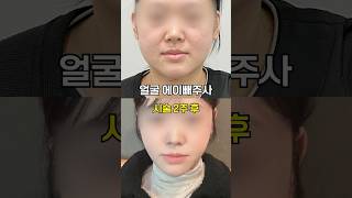 이중턱 시술 전후