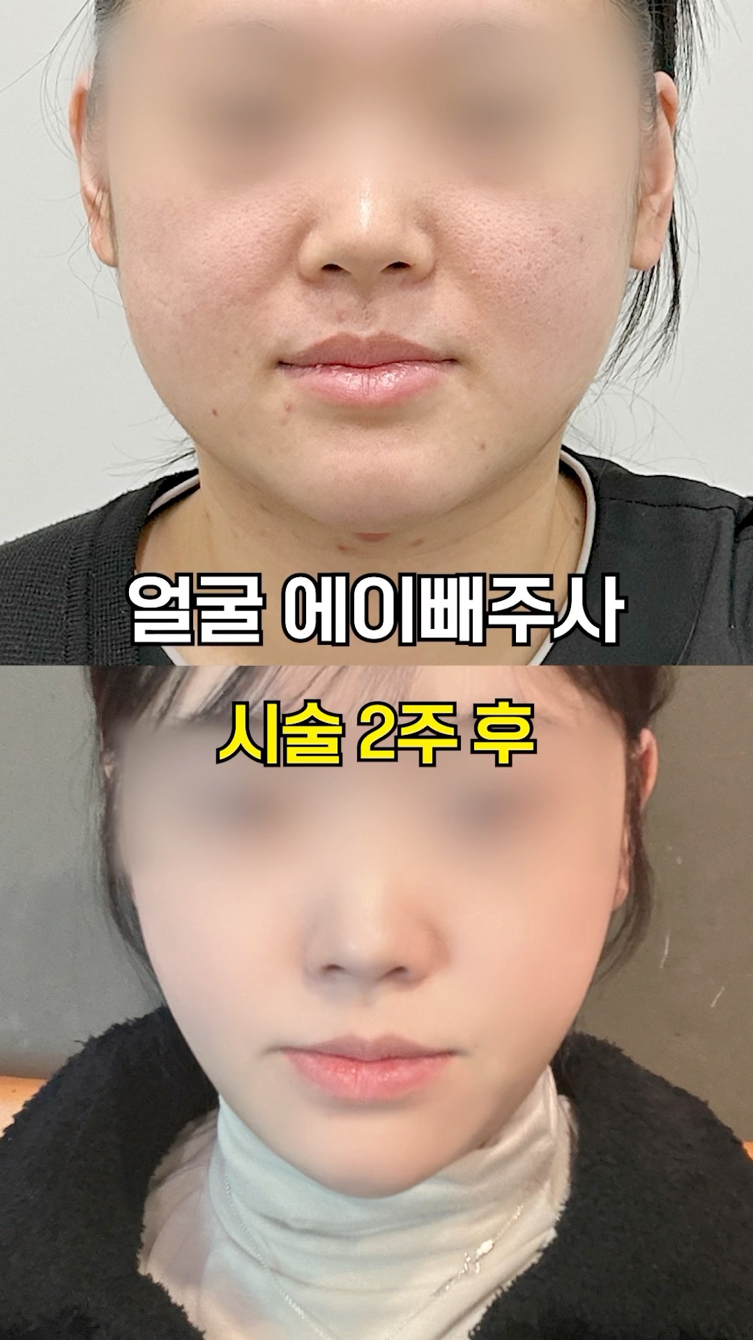 이중턱 시술 전후