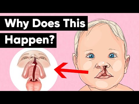 Cleft Lip & Cleft Palate Explained