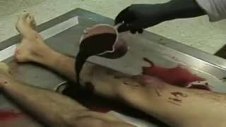 AUTOPSIA MEDICO LEGAL