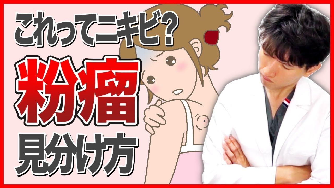 粉瘤とは？ 原因・治し方、そしてニキビとの違いについて 【医師が解説】 粉瘤ができやすい方の特徴や、つぶしてはいけない理由、炎症を起こす前に治療する重要性についてもご紹介します。