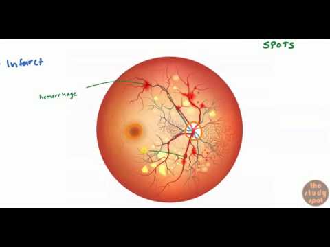 Diabetes mellitus icd 10 code