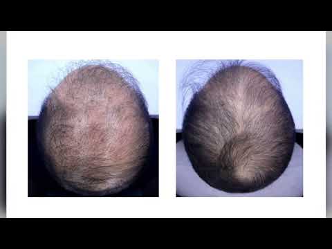탈모주사치료 그리고 모발이식 효과는요?