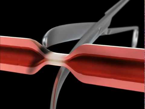 maXium® and marClamp® in hysterectomy – Part 1