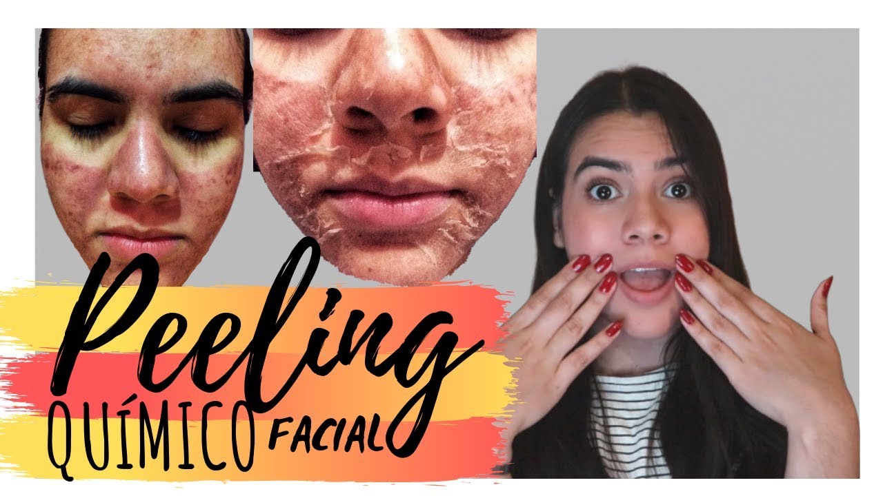 Watch MI EXPERIENCIA PEELING QUÍMICO FACIAL l ACNÉ l PROCESO - ROCIO LUNA Now MI EXPERIENCIA PEELING QUÍMICO FACIAL l ACNÉ l PROCESO - ROCIO LUNA