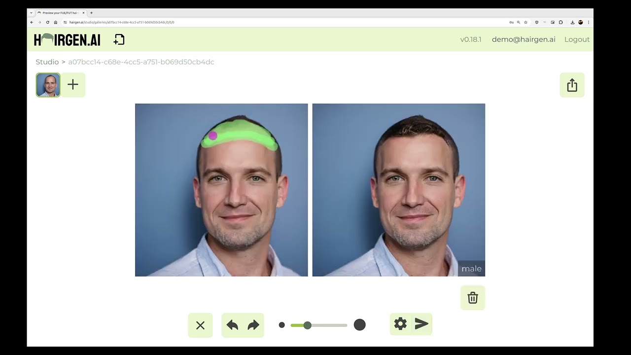 Use AI to Preview a Hair Transplant