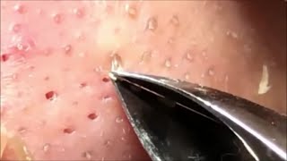 [問卦] 看過擠粉刺的影片是不是回不去了？