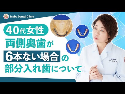 40代女性、両側奥歯が6本ない場合の部分入れ歯について