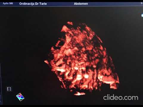 Kolor dopler 3D SMI c bubrega