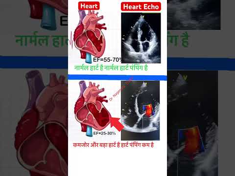 Normal heart Ef=55-70% & Heart failure EF=25-30% Echo l #echo #shorts