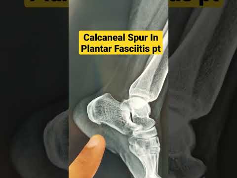 Calcaneal Spur In Plantar Fasciitis pt..Dr Sai Chandra