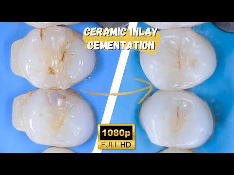 Inlay Delivery With Warm Composite | A Biomimetic Approach