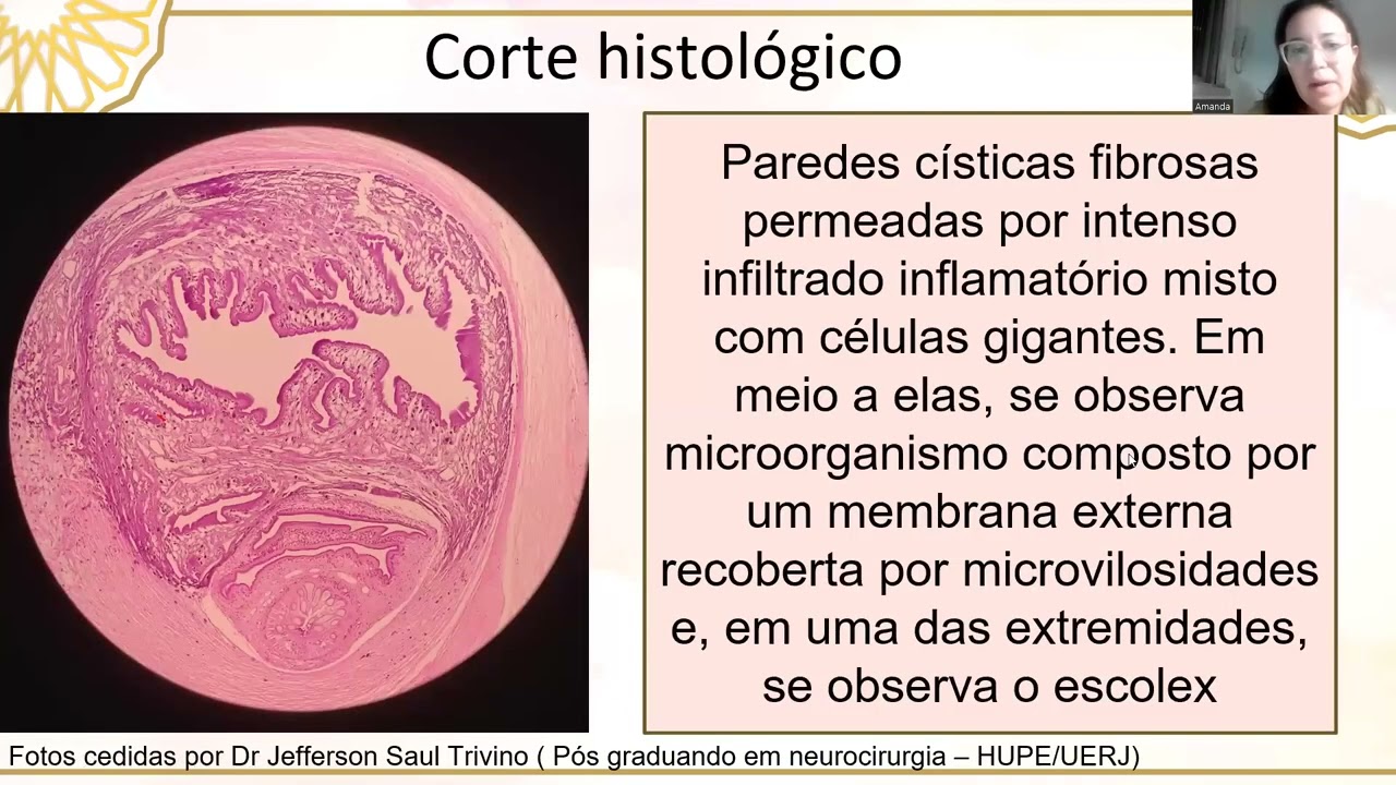06/2023 - Caso: Investigação de crise convulsiva em adulto sem comorbidades prévias