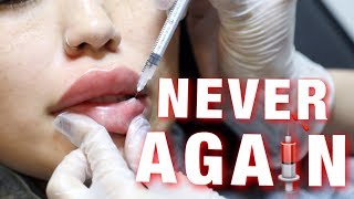 OMG I CAN&#39;T BELIEVE I DISSOLVED MY LIP FILLER!!!!!!!!