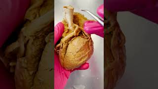 Download lagu Why Aspirin Helps During a Heart Attack mp3 Download lagu Why Aspirin Helps During a Heart Attack mp3