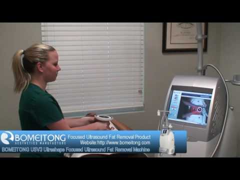 USV3 Ultrashape Focused Ultrasound Fat Removal Machine Actual Operation