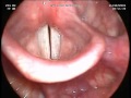 N° 7 bis les cordes vocales  larynx