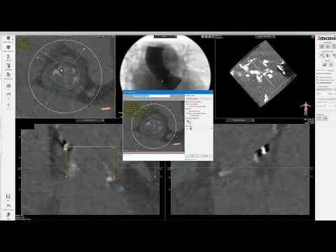 3Mensio CT Pre-case Planning: Valve-in-Valve TAVR in Mosaic