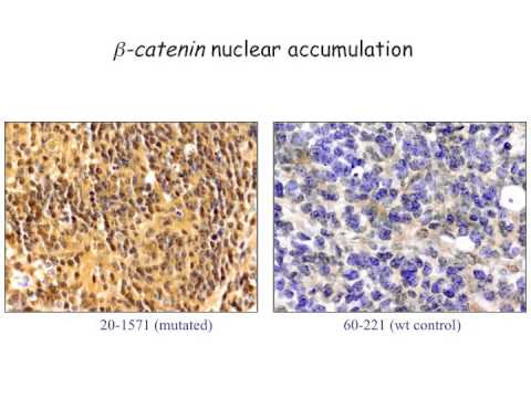 Whole Genome CN in Stratification and Diagnosis of Brain Tumor Patients