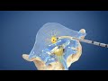 Intracept® Procedure for Chronic Low Back Pain | Cantor Spine Institute