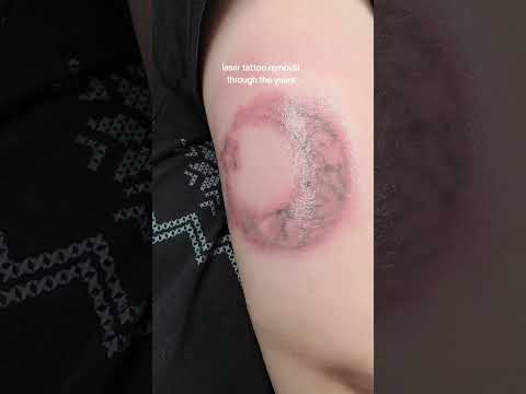 the day I got the tattoo and then 7 laser tattoo removal sessions later. tattoo update!