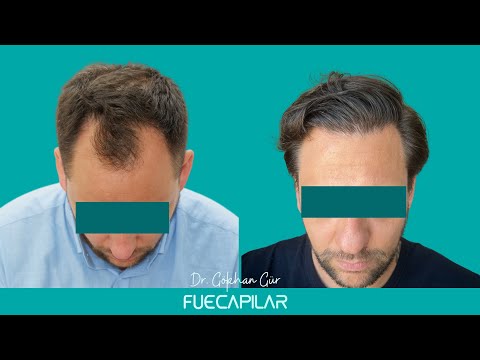FUE Hair Transplant (3236 Grafts NW IV) by Dr Gokhan Gür - FUECAPILAR, Istanbul, Turkey