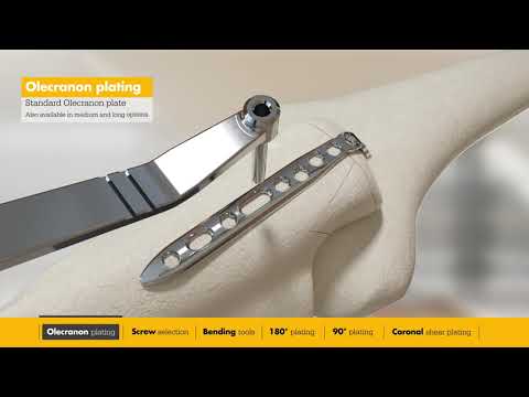 Evolve Elbow Plating System | Surgical Animation