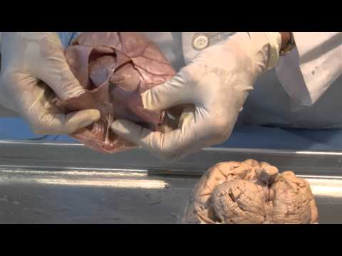 The Meninges: Neuroanatomy Video Lab - Brain Dissections