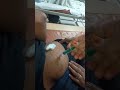 Intramuscular Injection Video For Nursing Students