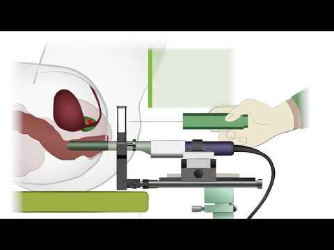 Zeitraum der Rehabilitation während der Operation an der Prostata Prostata bei Männern, was