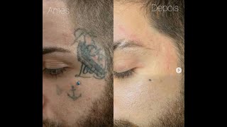 Resultado Final Remoção de Tatuagem no Rosto