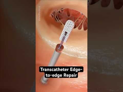 Repairing a leaky mitral valve in your heart (3D animation)