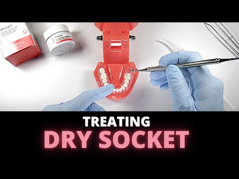 Tips For Managing Dry Socket (Alveolar Osteitis)