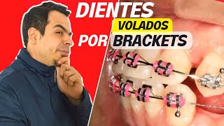 DIENTES VOLADOS O HACIA AFUERA DESPUÉS DE LA ORTODONCIA / ¿POR QUÉ PASA ESTO