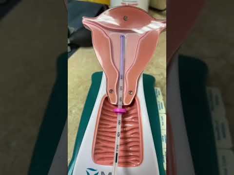 IUD INSERTION