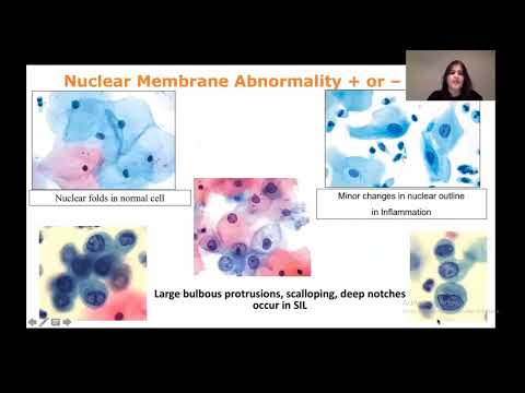 How to report ASCUS, LSIL,HSIL and SCC In PAP screening | cervical cytology part 2 | Bathesda System