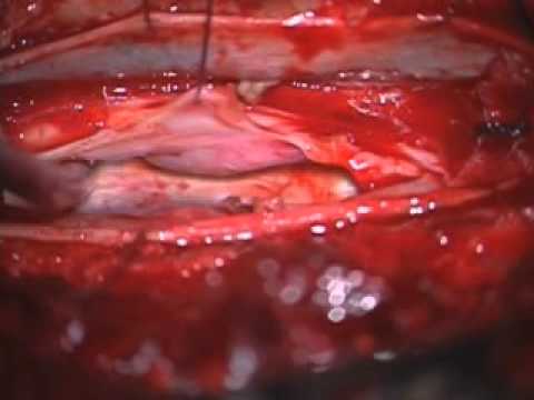 Reduction of anterior thoracic spinal cord herniation through duplicated dura mater