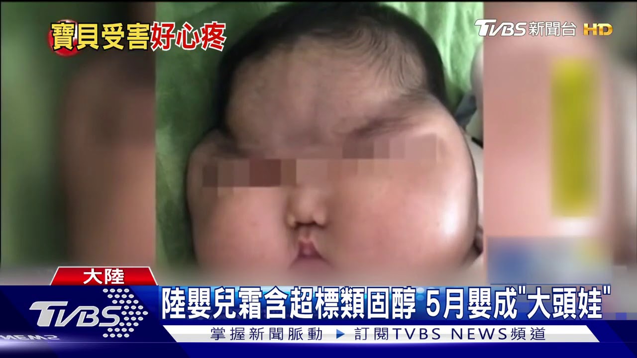 陸嬰兒霜含超標類固醇 5月嬰成「大頭娃」