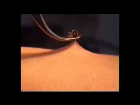Pinworms szoptatás közben