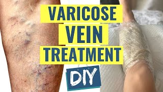 How to Treat Varicose Veins at Home | Natural Varicose Vein Treatment | Fix Varicose Veins