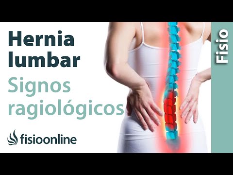 Hernia discal lumbar y protrusión discal - Signos radiológicos