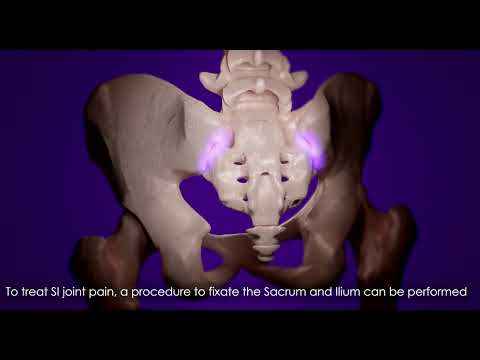 SiLO TFX™ The Transfixing SI Joint Fusion System