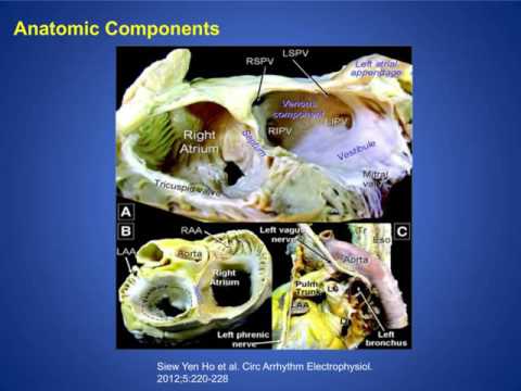 Key Factors of a Left Atrial Appendage Closure Program