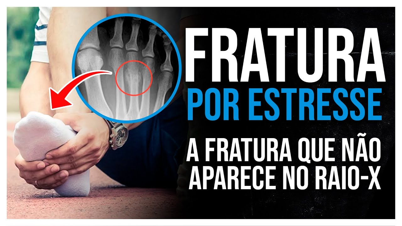 FRATURA POR ESTRESSE | FRATURA QUE NÃO APARECE NO RAIOX