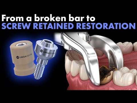 From a broken bar to screw retained restoration