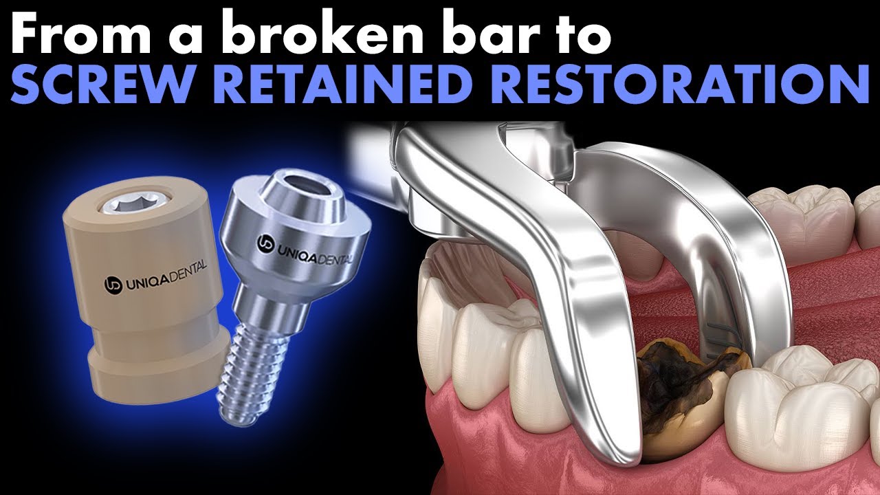 From a broken bar to screw retained restoration