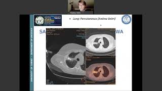 Lung & Percutaneous Approach – Andrea Veltri