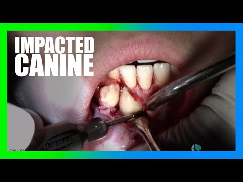 Impacted Canine Surgery