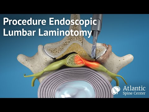 Procedure Endoscopic Lumbar Laminotomy