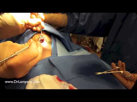 download lagu mp3 mp4 Chin Augmentation Philippines, download mp3 Chin Augmentation Philippines free download, download mp3 Chin Augmentation Philippines